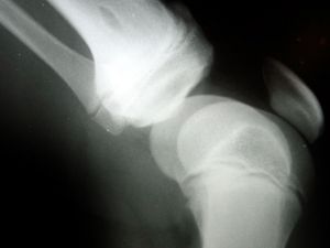 knee bones